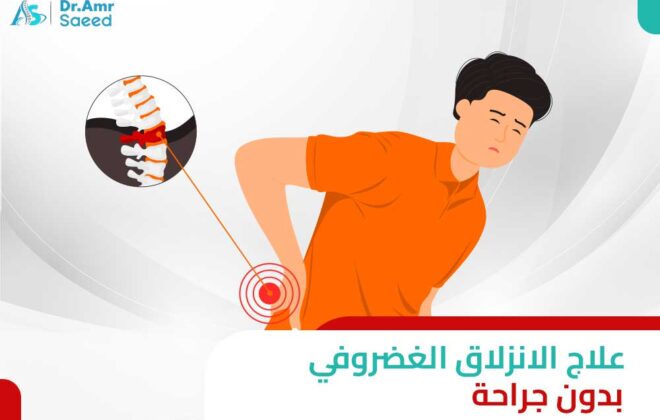 علاج الانزلاق الغضروفي بدون جراحة